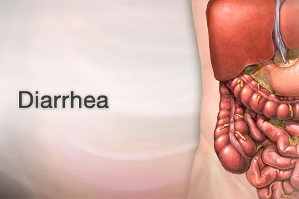 Diarrhea Disease Cure - Bewell Bali